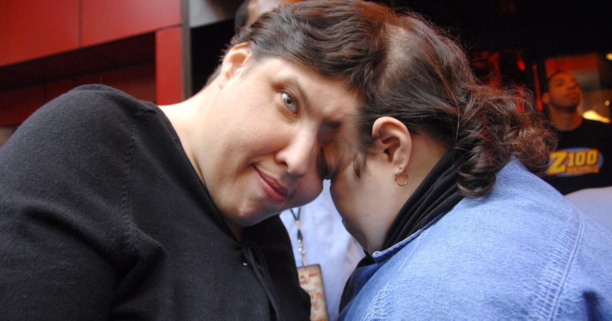 Meet The World Oldest Conjoined Twins, Lori and George Schappell